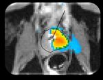 Incision & Radiation-Free Surgery Real-Time MR Guided Ultrasound Therapies CORPORATE PRESENTATION | January 2019 - Profound Medical