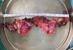 Congenital Uterine Anomaly and Pelvic Organ Prolapse: A Rare Case of Pelvic Organ Prolapse in a Complete Bicornuate Uterus with Successful ...