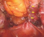 Congenital Uterine Anomaly and Pelvic Organ Prolapse: A Rare Case of Pelvic Organ Prolapse in a Complete Bicornuate Uterus with Successful ...