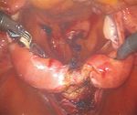 Congenital Uterine Anomaly and Pelvic Organ Prolapse: A Rare Case of Pelvic Organ Prolapse in a Complete Bicornuate Uterus with Successful ...