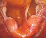Congenital Uterine Anomaly and Pelvic Organ Prolapse: A Rare Case of Pelvic Organ Prolapse in a Complete Bicornuate Uterus with Successful ...