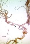 Usefulness of 3D Digital Subtraction Angiography in the Endovascular Approach of Cerebral Aneurysms