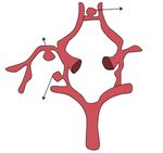 Usefulness of 3D Digital Subtraction Angiography in the Endovascular Approach of Cerebral Aneurysms