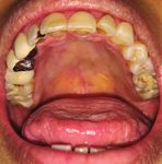 Xerostomia - An Unknown Oral Manifestation in AAA Syndrome - Open Journal Systems