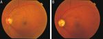Central retinal artery occlusion and optic neuropathy secondary to platelet rich plasma injection: a case report