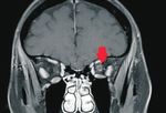 Central retinal artery occlusion and optic neuropathy secondary to platelet rich plasma injection: a case report