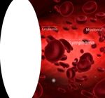A NEW ERA for the treatment of blood diseases Corporate Presentation - July 2021 - London Stock Exchange