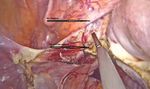 Laparoscopic single site surgery hysterectomy and bilateral salpingectomy for a patient with abnormal uterine bleeding-adenomyosis: a case report ...