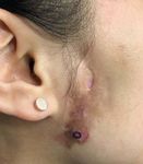 Kikuchi-Fujimoto disease preceded by lupus erythematosus panniculitis: do these findings together herald the onset of systemic lupus erythematosus?