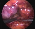 Patients with persistent atrial fibrillation?