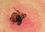 Ticks & Tick-borne Illnesses in Alabama - Alabama Department of Public Health