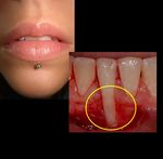 The Importance of Oral and Dental Health in College Students - ACHA 2016 - San Francisco, CA