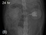 Recurrent hydronephrosis and spontaneous renal rupture caused by lymphoplasmacytic inflammation in a cat