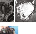 Case Report Two Cases of Ectopic Pregnancy Mimicking Gestational Trophoblastic Disease