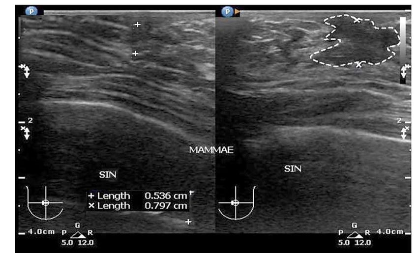 Ultrasound Examination Of Gynecomastia Case In Male Patient Case Report