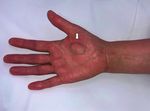 Carpal Tunnel Syndrome Caused by Lipofibromatous Hamartoma of the Median Nerve