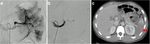 SPLEnic salvage and complications after splenic artery EmbolizatioN for blunt abdomINal trauma: the SPLEEN-IN study