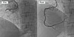 Acute aortic dissection with highly compressed true lumen: unanticipated pitfall of point- of- care ultrasonography