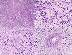 Xanthogranulomatous pyelonephritis with calculus migration into the psoas abscess: an unusual complication - SciELO