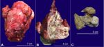 Xanthogranulomatous pyelonephritis with calculus migration into the psoas abscess: an unusual complication - SciELO