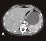 True giants' splenic cysts: report of two cases with laparoscopic approach