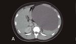 True giants' splenic cysts: report of two cases with laparoscopic approach