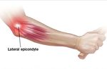 What is Tennis Elbow? - Patient Information Leaflet - University Hospitals Plymouth NHS Trust Physiotherapy Department Derriford Road Plymouth ...