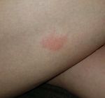 Cytotoxic spider bites - cases of mistaken identity