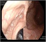 Management and Repair of Diaphragmatic Hernia during Pregnancy with a Double Approach