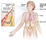 Can NBTXR3 turn anti-PD-1 non responders into responders and deepen anti-PD-1 response in naïve patients? - Nanobiotix