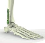 Swiss Foot and Ankle Society Symposium 2021 - Osteochondral lesions and calcaneal fractures Balgrist University Hospital, Zurich Friday, June ...