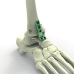 Swiss Foot and Ankle Society Symposium 2021 - Osteochondral lesions and calcaneal fractures Balgrist University Hospital, Zurich Friday, June ...