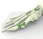 Swiss Foot and Ankle Society Symposium 2021 - Osteochondral lesions and calcaneal fractures Balgrist University Hospital, Zurich Friday, June ...