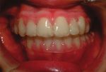 Noonan Syndrome in 12 -Year-Old Male: Case Report and Orthodontic Management of the Occlusion - Sciendo