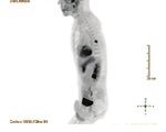 EXAMINING THE VALUE OF DIGITAL PET/CT - Philips