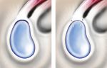 Rehabilitation Guidelines For SLAP Lesion Repair - UW Health