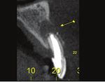 Prosthetic rehabilitation using a cone morse dental implant and xenogen biomaterial in an aesthetic area: A case report