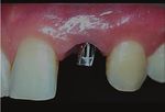 Prosthetic rehabilitation using a cone morse dental implant and xenogen biomaterial in an aesthetic area: A case report