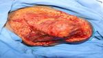 Cutaneous mucormycosis or black fungus of right shoulder regionrare case report