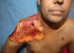 Cutaneous mucormycosis or black fungus of right shoulder regionrare case report