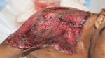 Cutaneous mucormycosis or black fungus of right shoulder regionrare case report