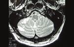 Sudden sensorineural hearing loss and vertigo associated with arterial occlusive disease: three case reports and literature review