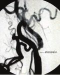 Sudden sensorineural hearing loss and vertigo associated with arterial occlusive disease: three case reports and literature review