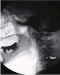 Sudden sensorineural hearing loss and vertigo associated with arterial occlusive disease: three case reports and literature review