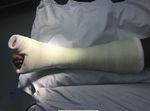 Post-Traumatic Hallux Valgus: A Modified Surgical Technique