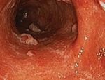 Guide to inflammatory bowel disease - bowel diseae - Southern.IML Pathology