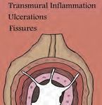 Guide to inflammatory bowel disease - bowel diseae - Southern.IML Pathology