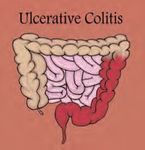 Guide to inflammatory bowel disease - bowel diseae - Southern.IML Pathology