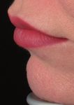 Mastering the art of lip rejuvenation: identifying patterns and techniques