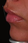 Mastering the art of lip rejuvenation: identifying patterns and techniques